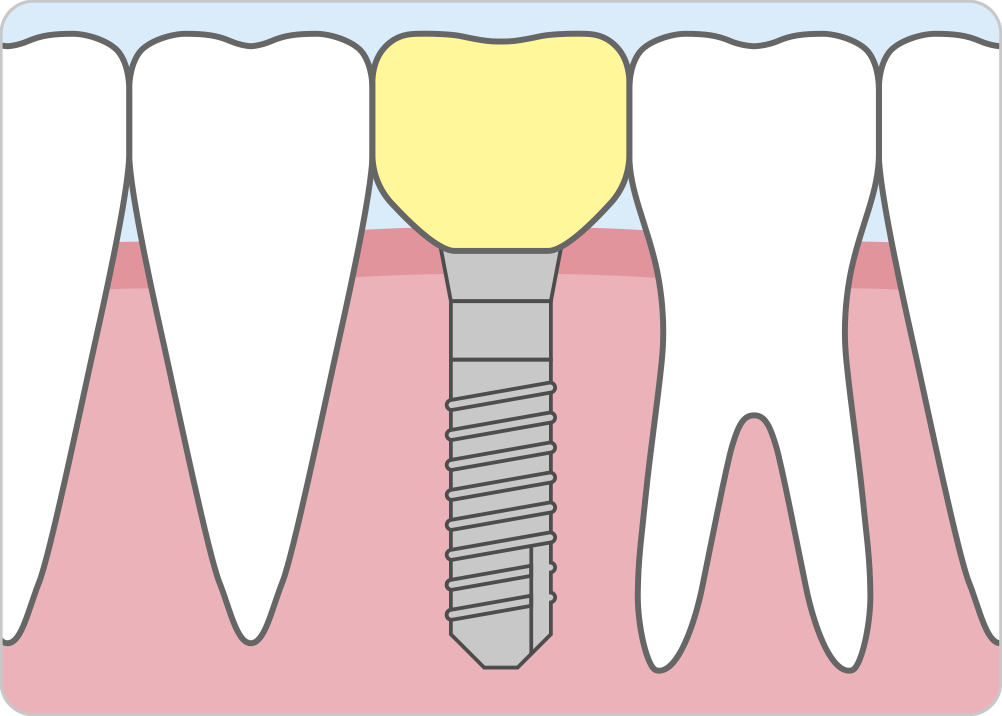 インプラント