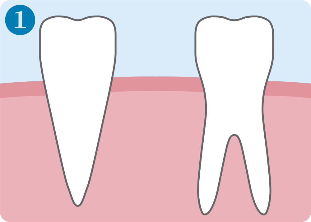 インプラント治療手順1