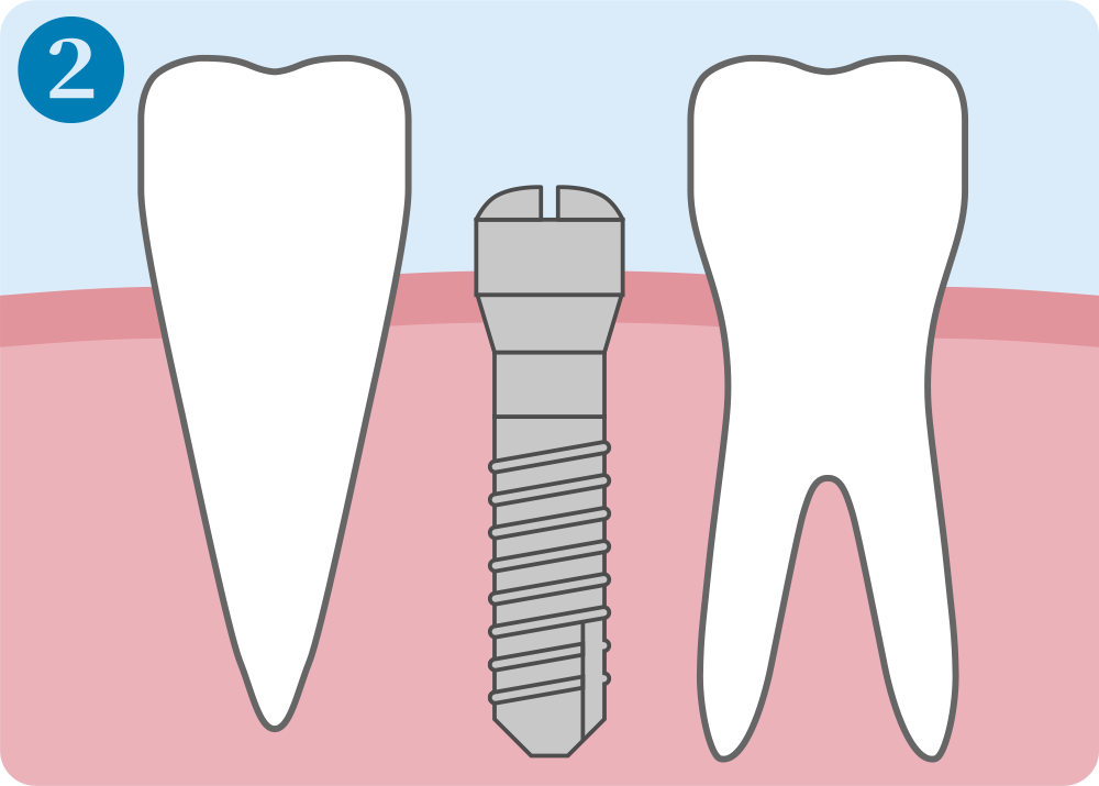 インプラント治療手順2