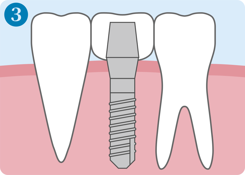 インプラント治療手順3