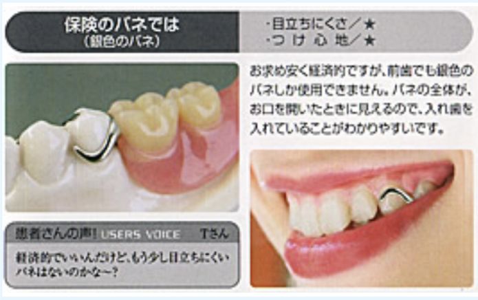 保険のバネ（銀色のバネ）：お求めやすく経済的ですが、前歯でも銀色のバネしか使用できません。バネの全体が、お口を開いた時に見えるので、入れ歯を入れていることが分かりやすいです。