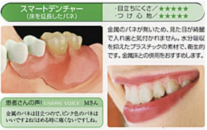 スマートデンチャー：金属のバネが無いため、見た目が綺麗で入れ歯と気づかれません。水分吸収を抑えたプラスチックの素材で、衛生的です。金属床との併用をおすすめします。